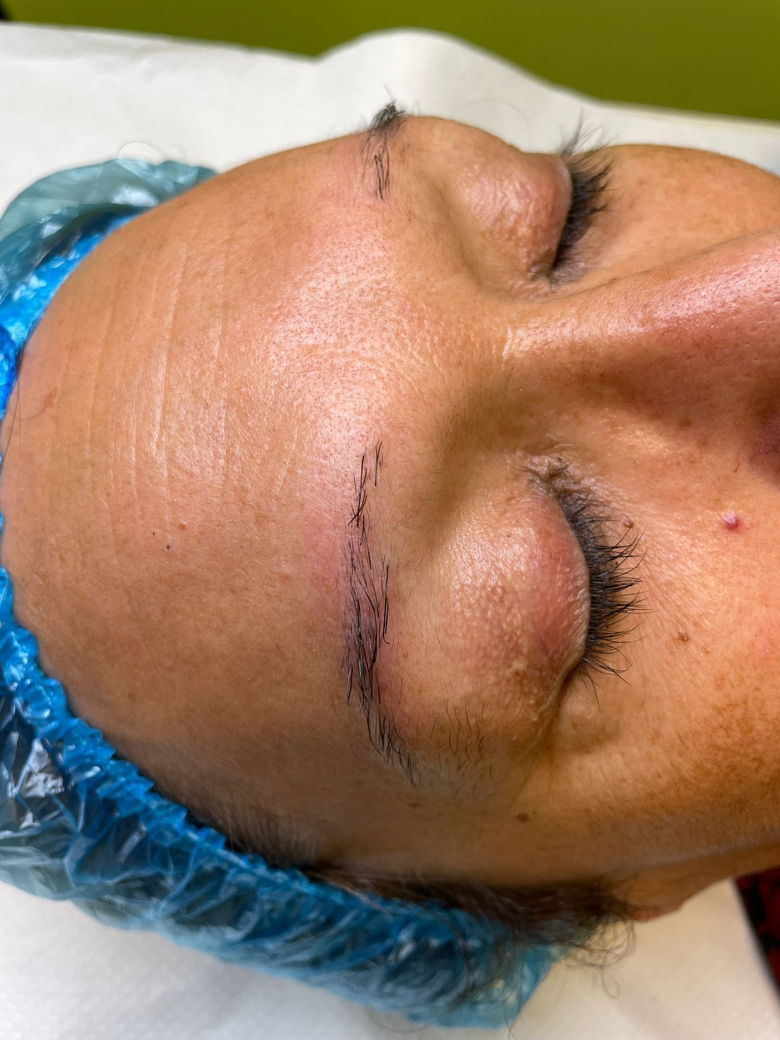 Tratamiento Estética 5